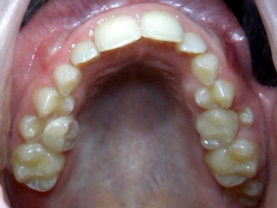 Oclusal Superior