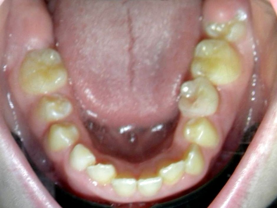 Oclusal Inferior