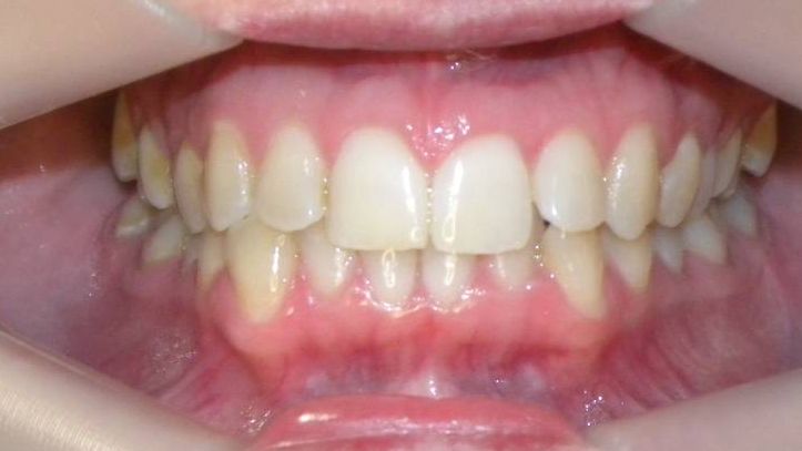 Frontal (Oclusión)