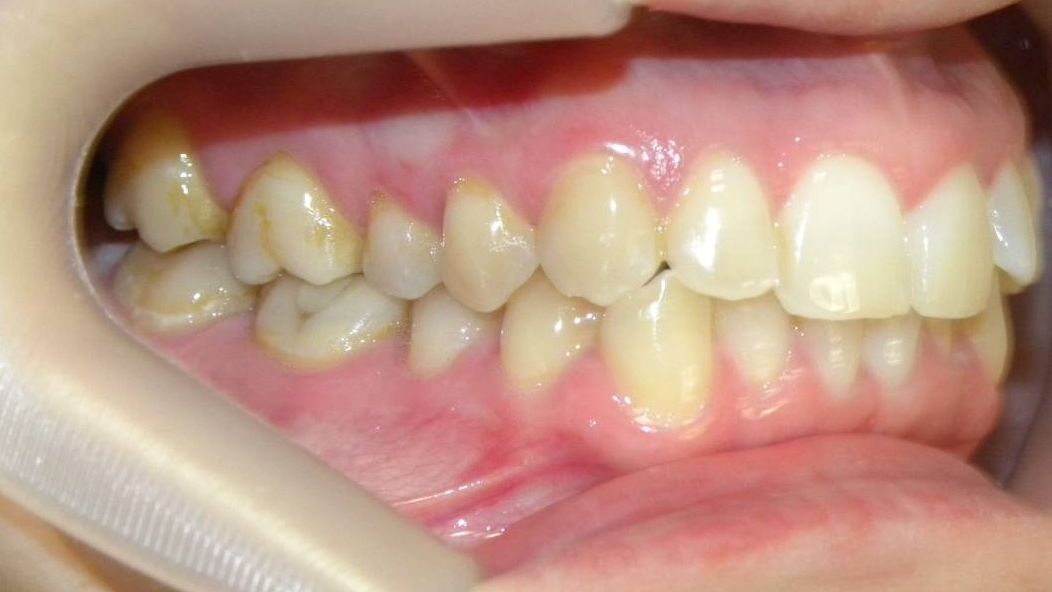 Lateral Derecha