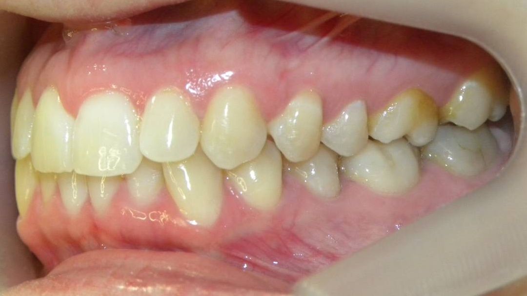 Lateral Izquierda