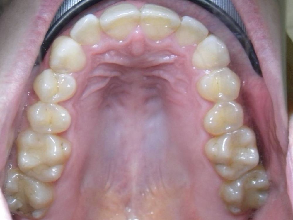 Oclusal Superior