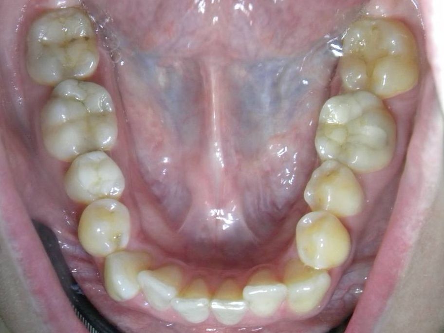 Oclusal Inferior