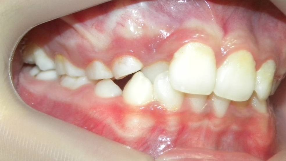 Lateral Derecha
