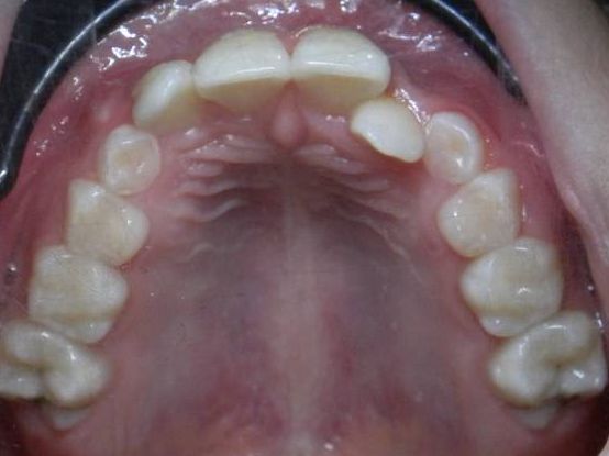 Oclusal Superior