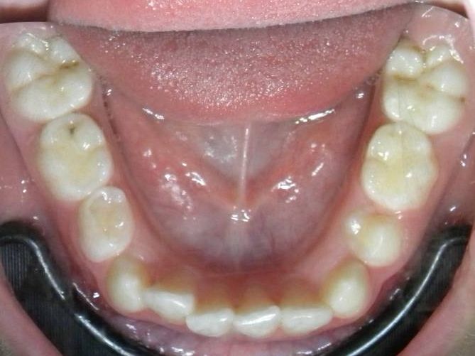 Oclusal Inferior