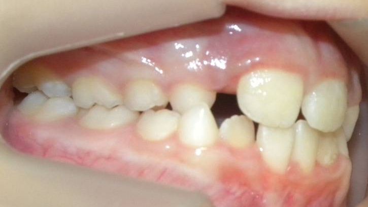 Lateral Derecha