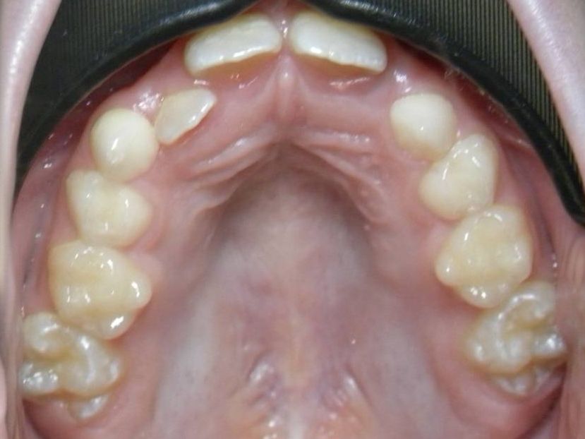 Oclusal Superior