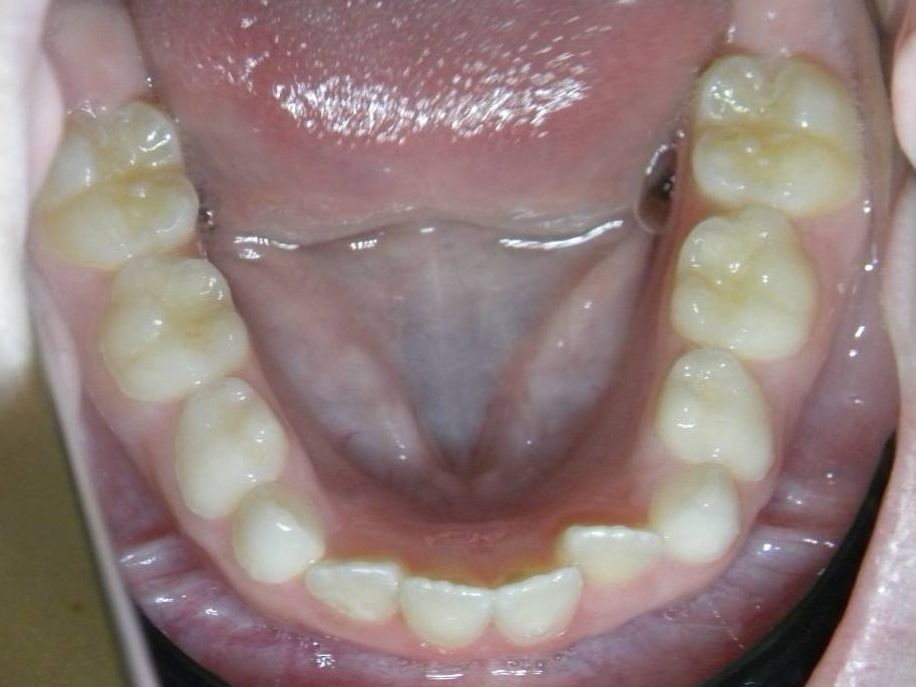 Oclusal Inferior