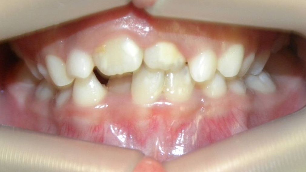 Frontal (Oclusión)