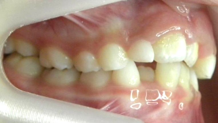 Lateral Derecha