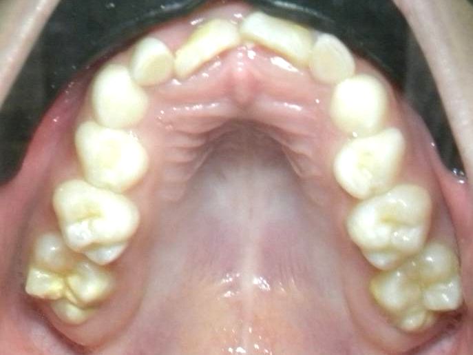 Oclusal Superior