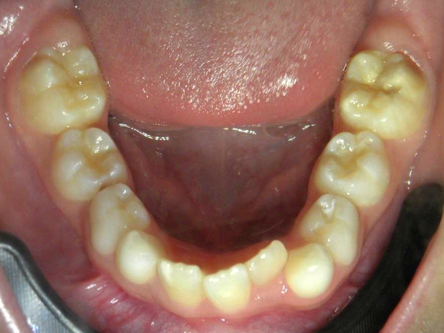 Oclusal Inferior