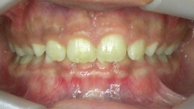 Frontal (Oclusión)