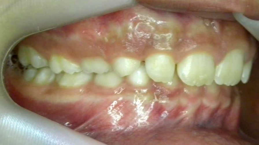 Lateral Derecha