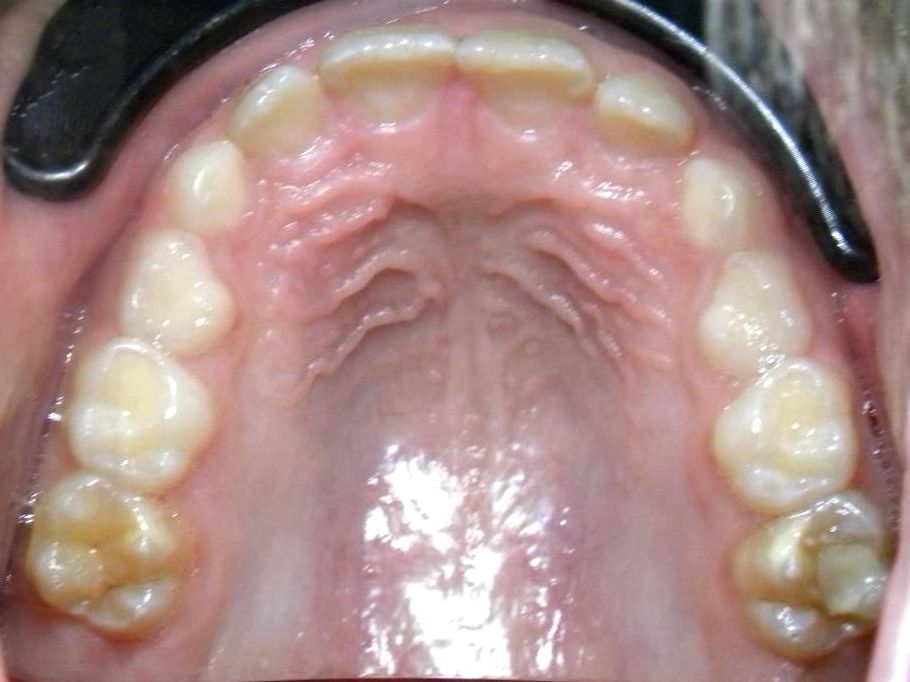 Oclusal Superior