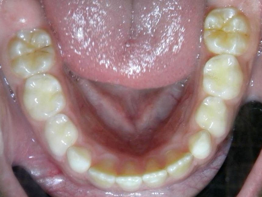 Oclusal Inferior