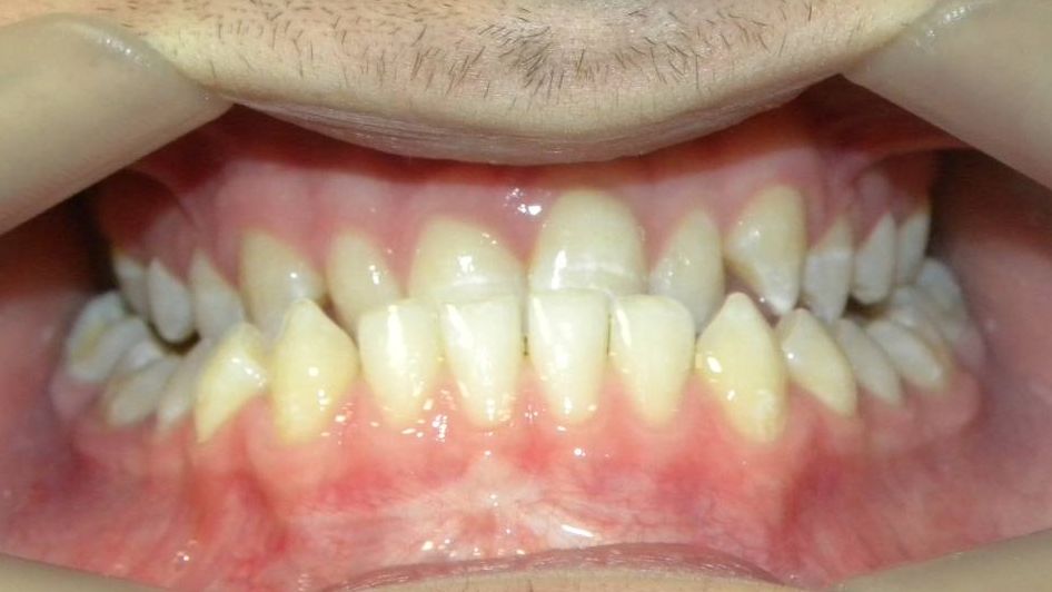Frontal (Oclusión)