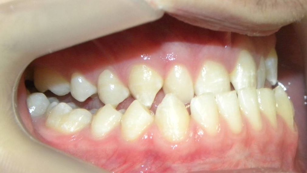 Lateral Derecha