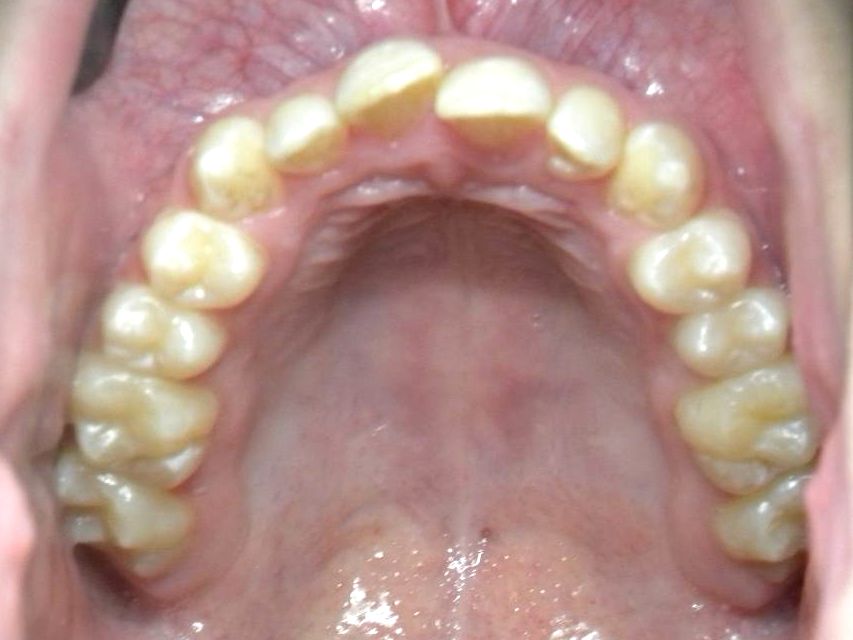 Oclusal Superior