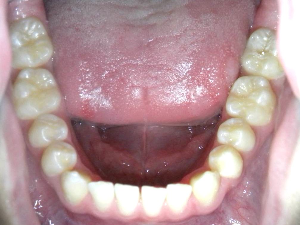 Oclusal Inferior