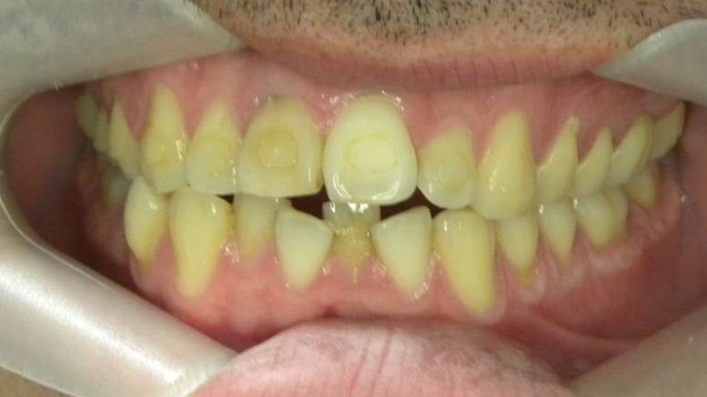 Frontal (Oclusión)