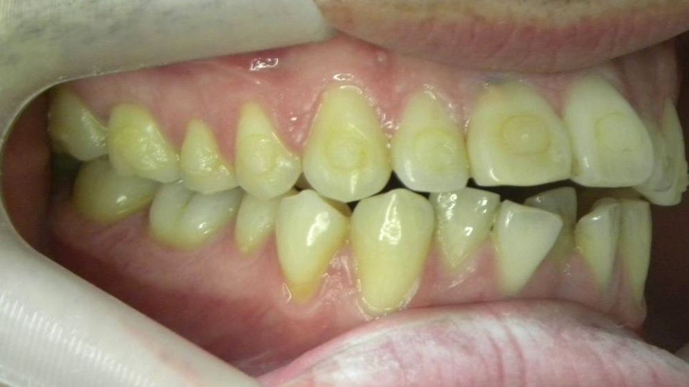 Lateral Derecha