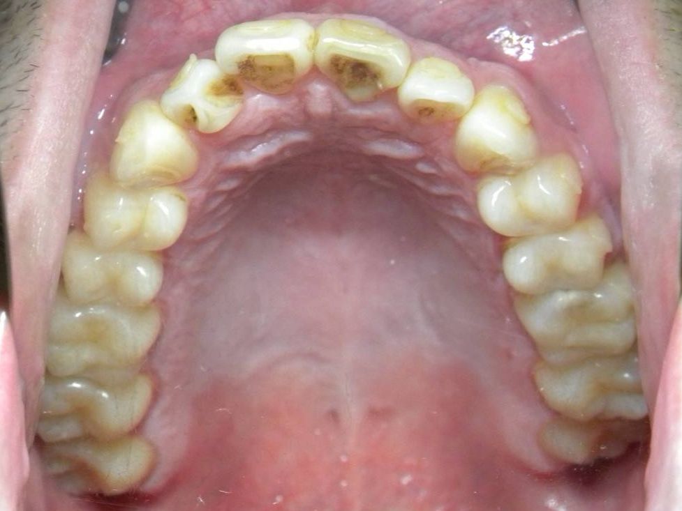 Oclusal Superior