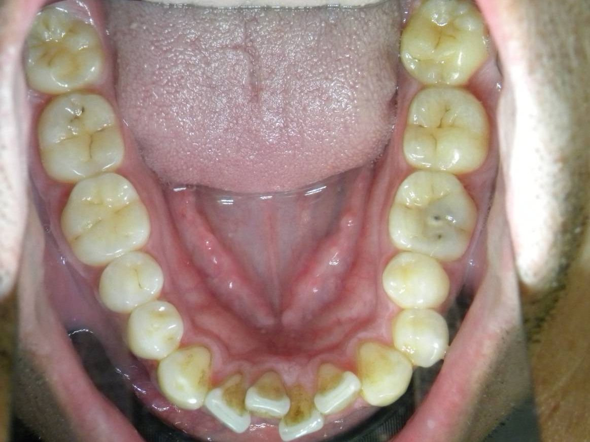 Oclusal Inferior