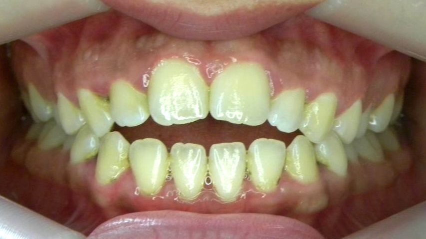 Frontal (Oclusión)