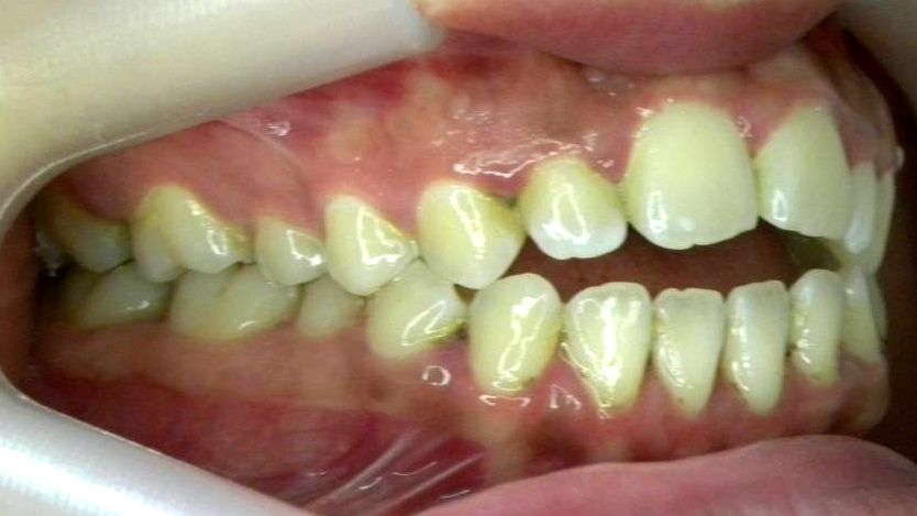 Lateral Derecha