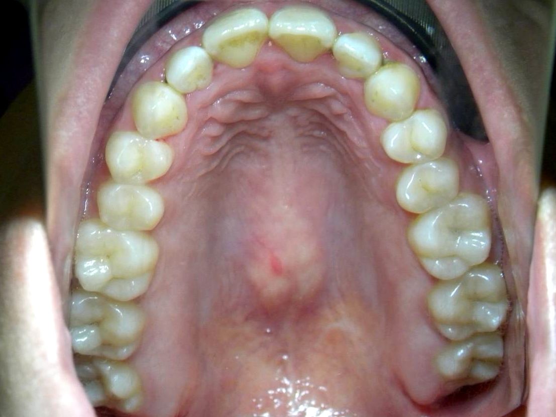 Oclusal Superior