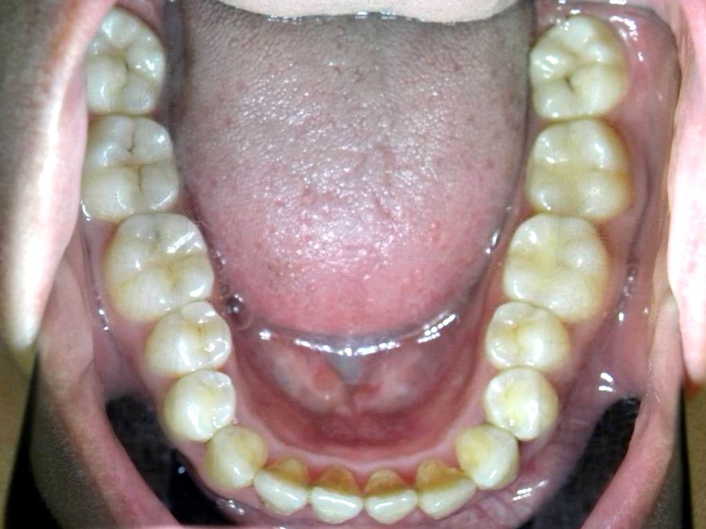 Oclusal Inferior