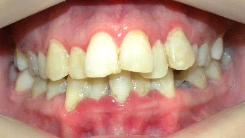 Frontal (Oclusión)