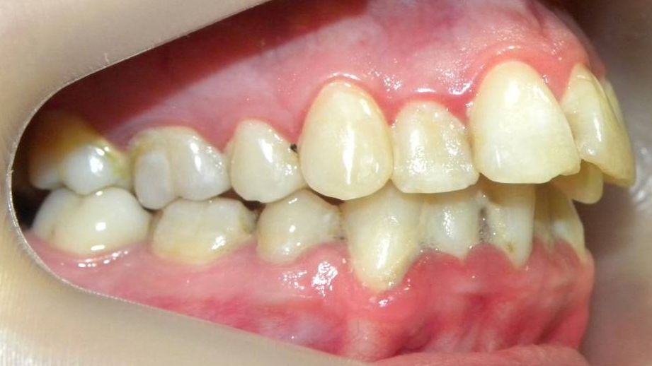 Lateral Derecha