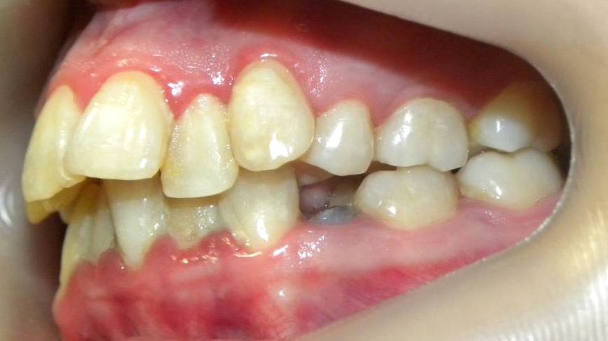 Lateral Izquierda