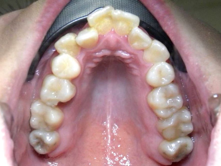 Oclusal Superior