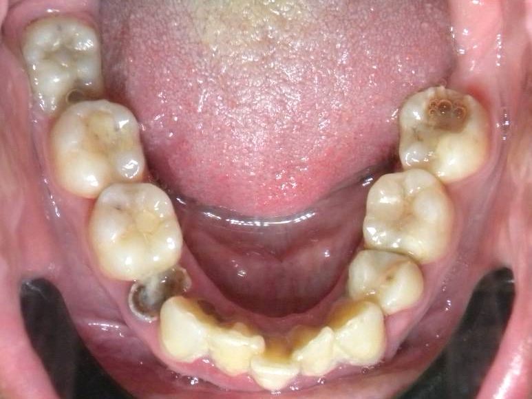 Oclusal Inferior