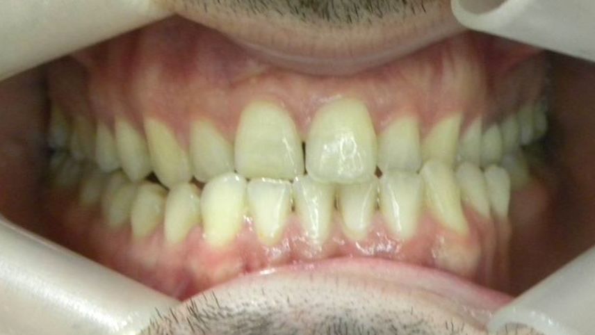Frontal (Oclusión)