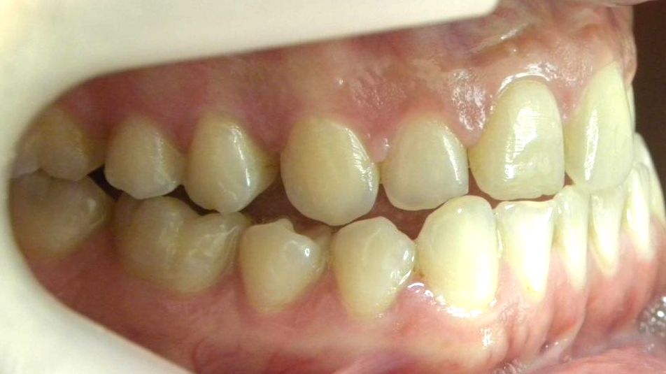Lateral Derecha