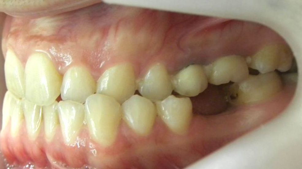 Lateral Izquierda
