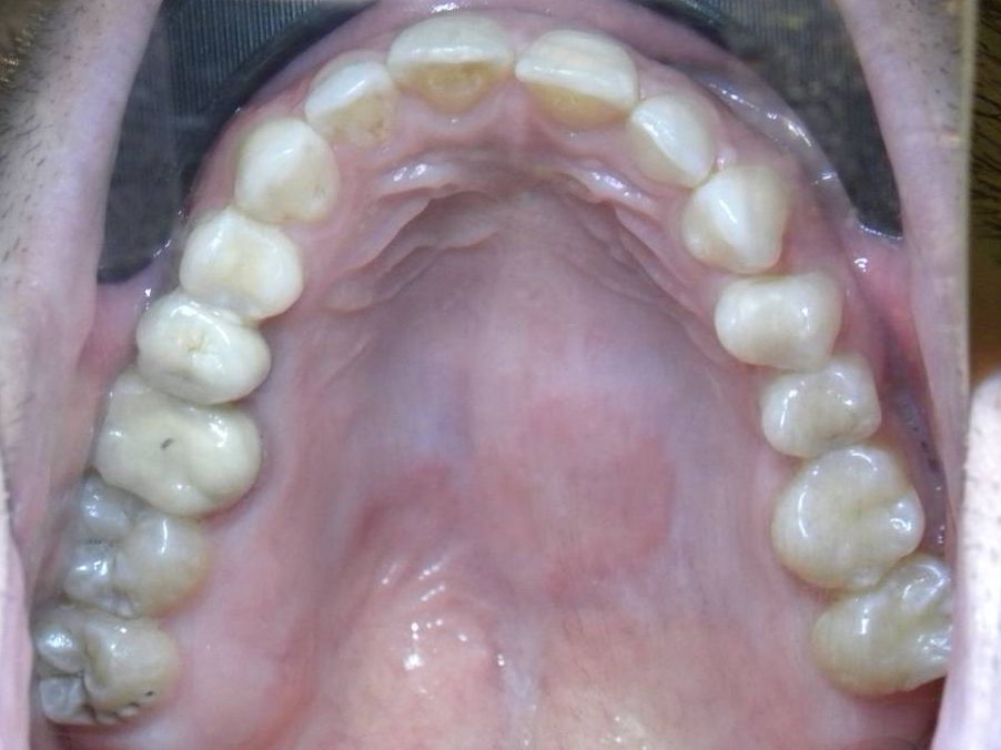 Oclusal Superior