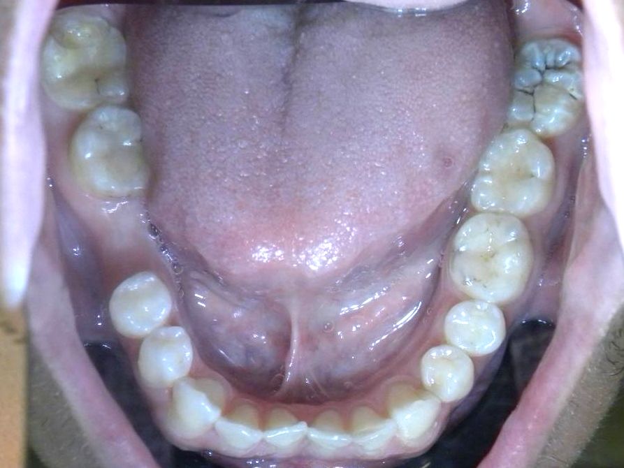 Oclusal Inferior