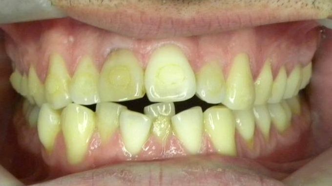 Frontal (Oclusión)