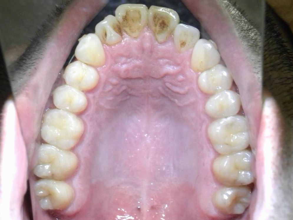 Oclusal Superior