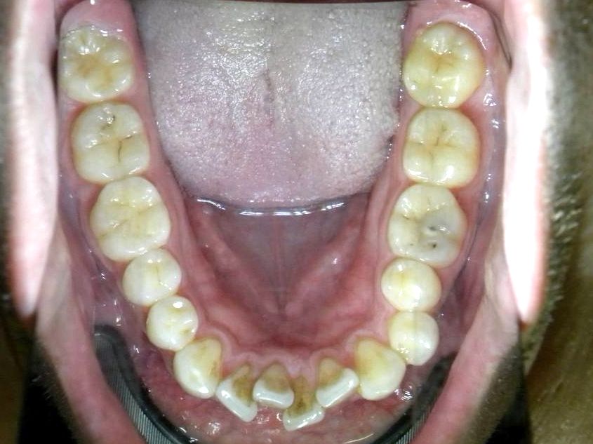 Oclusal Inferior