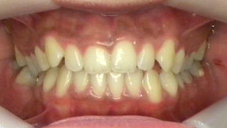 Frontal (Oclusión)