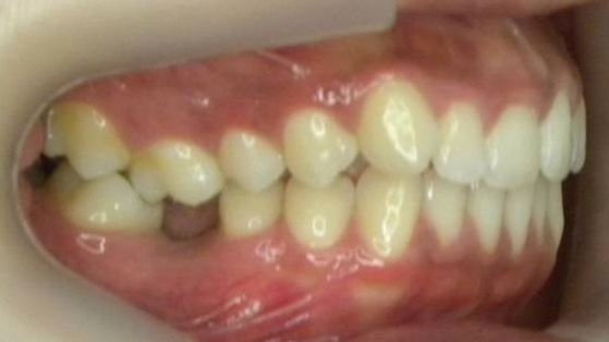 Lateral Derecha