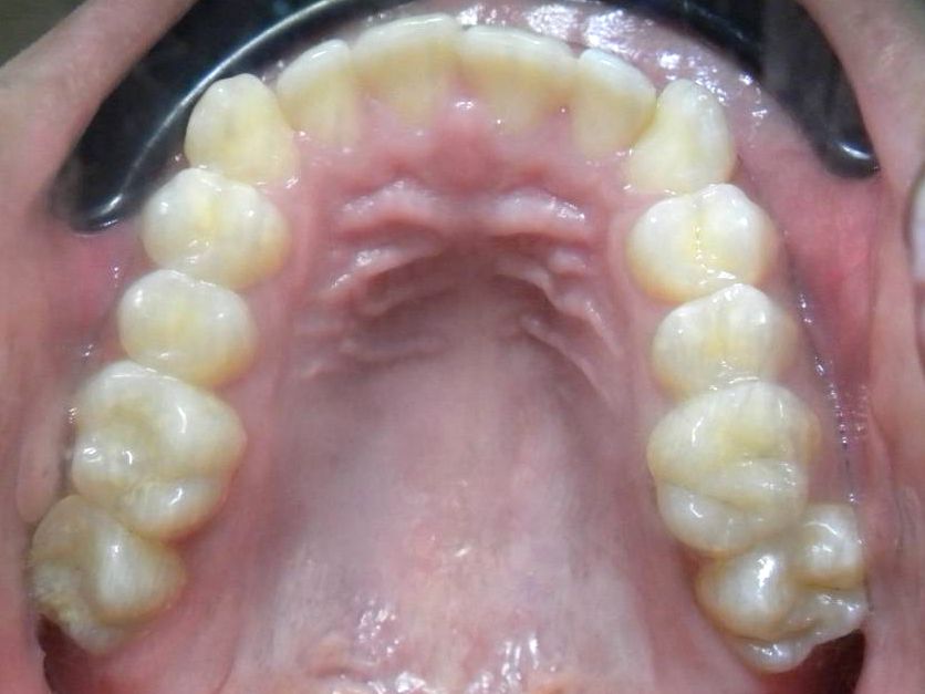 Oclusal Superior