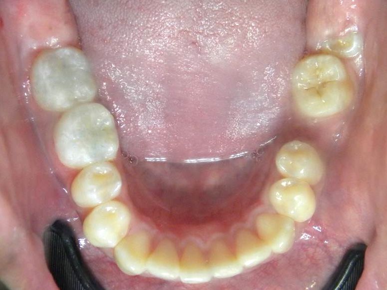 Oclusal Inferior